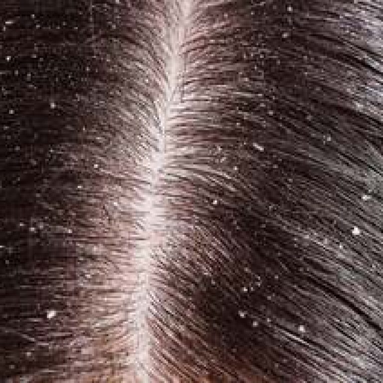 dandruff